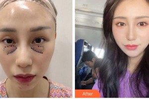 嘉興愛爾眼科醫(yī)院王春芳整形價(jià)格表附外切祛眼袋案例展示