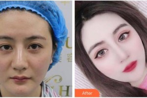 嘉興愛爾眼科醫(yī)院李邵偉整形價(jià)格表附眼部綜合案例展示