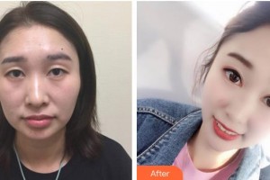 嘉興愛爾眼科醫(yī)院李光輝整形價(jià)格表附埋線雙眼皮案例展示