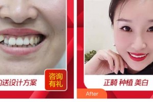 嘉興口腔醫(yī)院張國平整形價(jià)格表附隱形托槽矯正案例展示