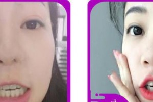 嘉興嘉誠口腔醫(yī)院王菊慶整形價(jià)格表附牙齒隱形矯正案例展示