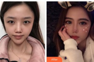 湖州尚麗醫(yī)療美容門診部譚成林整形價格表附眼部綜合案例展示