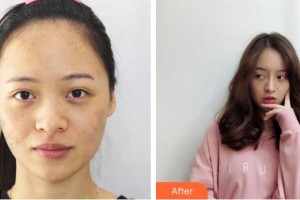 湖州尚麗醫(yī)療美容門診部宋君整形價格表附激光祛斑案例展示