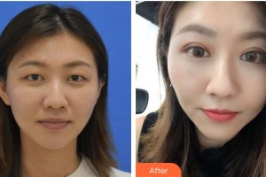 湖州長興愛爾眼科醫(yī)院趙英杰整形價格表附定點雙眼皮案例展示
