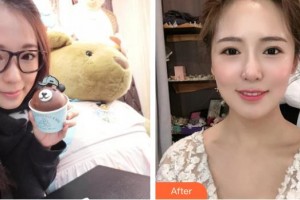 湖州潘震亞口腔診所潘震亞整形價格表附金屬托槽矯正案例展示