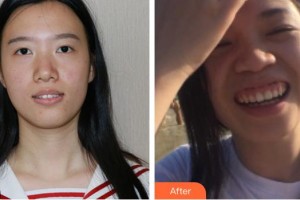 湖州金鉑利口腔門診部李光明整形價格表附隱形托槽矯正案例展示