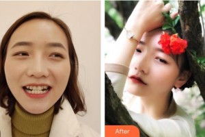 湖州金鉑利口腔門診部宋園整形價格表附牙齒隱形矯正案例展示