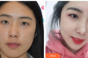 湖州愛爾眼科醫(yī)院丁慰祖整形價格表附激光去眼袋案例展示