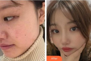 湖州愛爾眼科醫(yī)院莫百軍整形價格表附切開雙眼皮案例展示