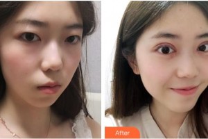 湖州愛爾眼科醫(yī)院俞臻整形價格表附開內(nèi)眼角案例展示