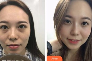 湖州愛爾眼科醫(yī)院陳健整形價格表附激光去眼袋案例展示