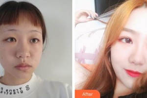 湖州愛爾眼科醫(yī)院聞萍整形價格表附切開雙眼皮案例展示