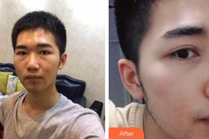 湖州愛爾眼科醫(yī)院褚惠英整形價格表附內(nèi)切祛眼袋案例展示