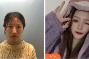 湖州愛爾眼科醫(yī)院吳新如整形價格表附眼部綜合案例展示