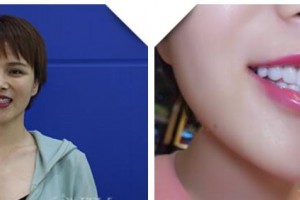 湖州鼎植口腔醫(yī)院詹傳華整形價格表附牙貼面案例展示