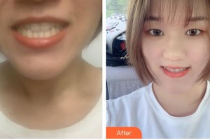 湖州鼎植口腔醫(yī)院曹振整形價格表附牙齒隱形矯正案例展示