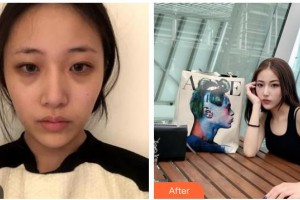 湖州長興愛爾眼科醫(yī)院周曉紅整形價格表附內切祛眼袋案例展示