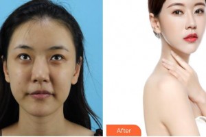 湖州長興愛爾眼科醫(yī)院高路整形價格表附開內眼角案例展示