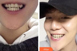 湖州溫馨口腔診所王大鵬整形價格表附牙齒矯正案例展示