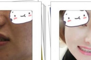 湖州金鉑利口腔門診部賈倩倩整形價格表附金屬托槽矯正案例展示