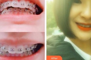 湖州陳景康牙科診所陳飛燕整形價格表附金屬托槽矯正案例展示