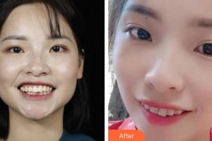 湖州陳景康牙科診所陳立整形價格表附金屬托槽矯正案例展示