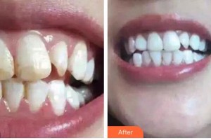 湖州鼎植口腔醫(yī)院李鳴元整形價格表附冷光美白案例展示