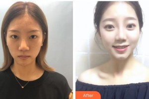 湖州市中心醫(yī)院眼科邱海雁整形價格表附眼部綜合案例展示