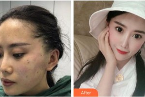 紹興陳榮法醫(yī)療整形美容診所陳榮法整形價格表附埋線提升案例展示