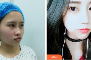 紹興華美整形美容醫(yī)院姚冬婷整形價格表附埋線提升案例展示