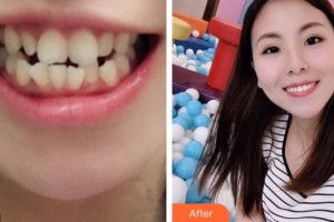 紹興市人民醫(yī)院醫(yī)療美容科王?；ㄕ蝺r格表附金屬托槽矯正案例展示