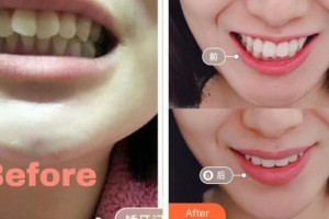 紹興德維口腔醫(yī)院張濤整形價格表附牙齒隱形矯正案例展示