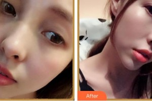 紹興市人民醫(yī)院醫(yī)療美容科徐永根整形價格表附眼鼻部手術(shù)案例展示