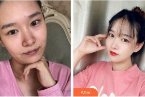 紹興市人民醫(yī)院醫(yī)療美容科陳宏整形價格表附抗衰案例展示