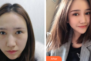 深圳美度醫(yī)療美容醫(yī)院朱凱整形價格表附去眼袋淚溝案例展示