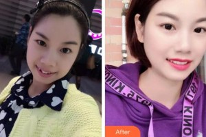 紹興博雅口腔醫(yī)院酈興整形價格表附金屬托槽矯正案例展示