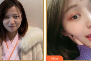 紹興愛爾眼科醫(yī)院周玲芬整形價格表附眼部綜合案例展示
