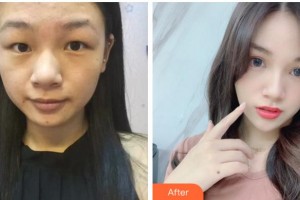 紹興愛爾眼科醫(yī)院梁麗瓊整形價格表附切開雙眼皮案例展示