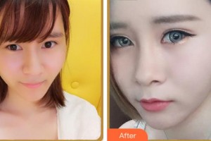 紹興愛爾眼科醫(yī)院王勝利整形價格表附眼部綜合案例展示