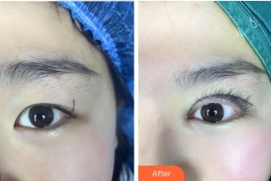 紹興愛爾眼科醫(yī)院郭雪琴整形價格表附眼部綜合案例展示