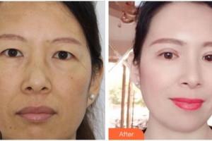 紹興愛爾眼科醫(yī)院史皞整形價格表附切開雙眼皮案例展示