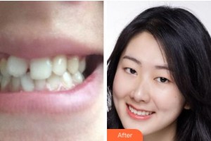 紹興越中口腔醫(yī)院鋒整形價格表附牙齒陶瓷矯正案例展示