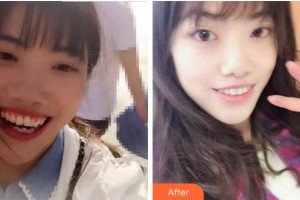 紹興越中口腔醫(yī)院陳琳整形價格表附牙齒陶瓷矯正案例展示