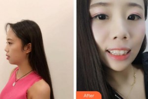 紹興越中口腔醫(yī)院朱松陽整形價格表附牙齒隱形矯正案例展示