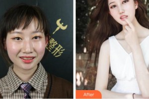 紹興市口腔醫(yī)院張志明整形價格表附牙齒隱形矯正案例展示