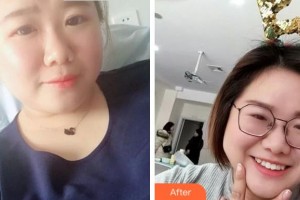 紹興市口腔醫(yī)院羅善峰整形價格表附牙齒隱形矯正案例展示