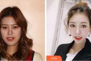 紹興市口腔醫(yī)院李齊齊整形價格表附隱形托槽矯正案例展示