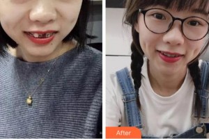 紹興市口腔醫(yī)院張侃整形價格表附金屬托槽矯正案例展示