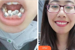 紹興市口腔醫(yī)院蔣建江整形價格表附金屬托槽矯正案例展示