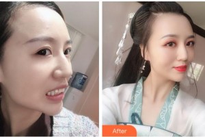 紹興市口腔醫(yī)院葉秋萍整形價格表附牙齒隱形矯正案例展示